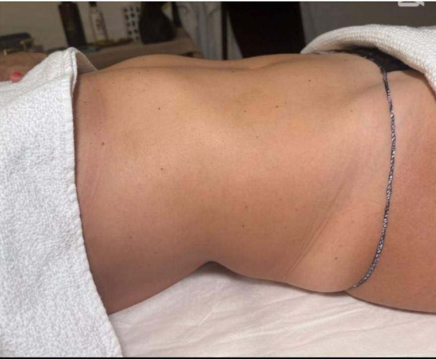 Before — Abdomen sculpting