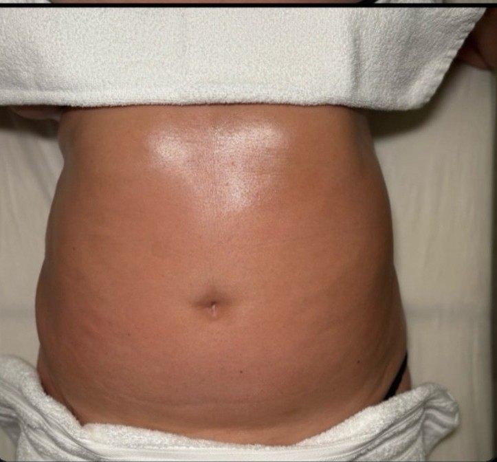 After — Body contour result